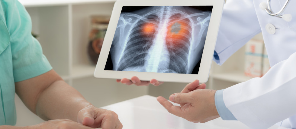NoduleNet: AI for Early Lung cancer Detection